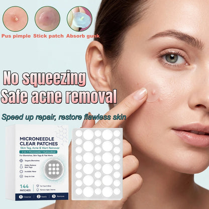 Microneedle Acne Patches for Blemishes