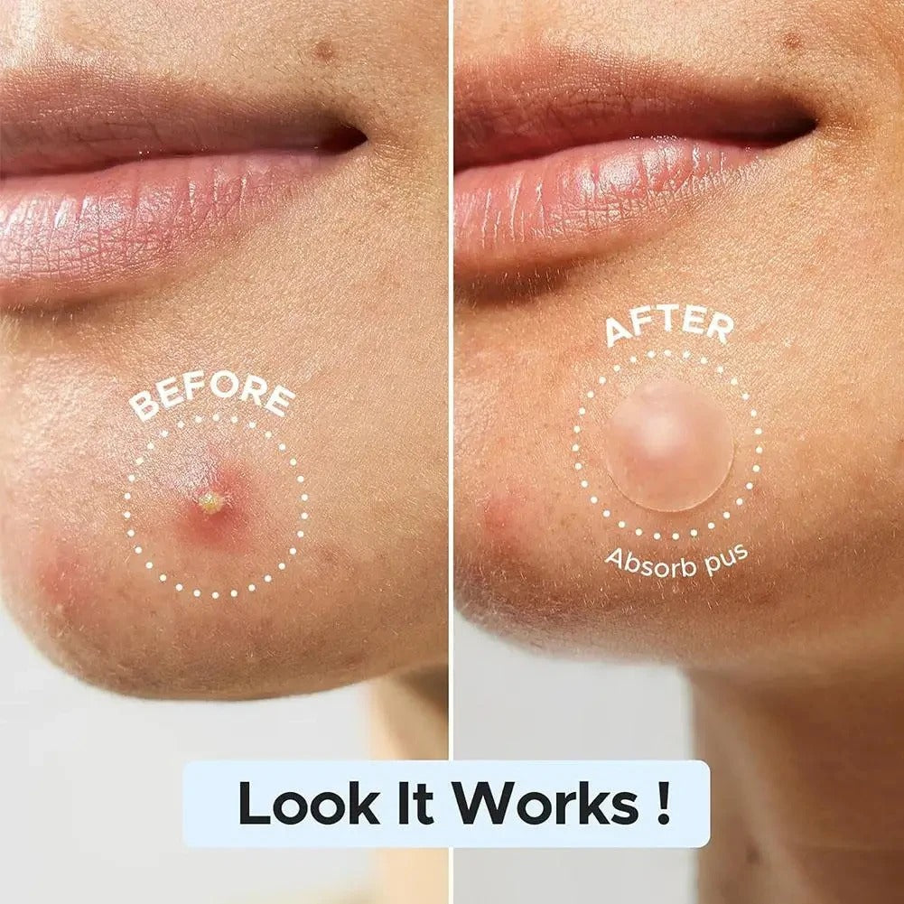 Microneedle Acne Patches for Blemishes