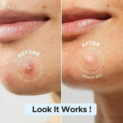Microneedle Acne Patches for Blemishes