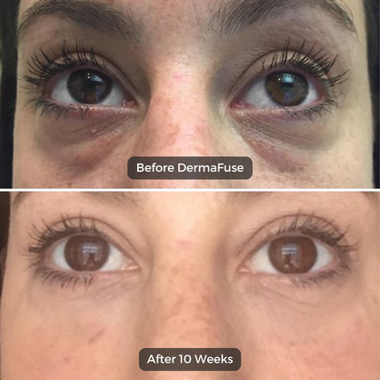 Advanced Dissolvable Microneedle Patches | 2,000 Micro-Infusion Needles with 90% Pure Hyaluronic Acid | Deep Hydration, Plumping & Anti-Aging Treatment for Under-Eye and Face