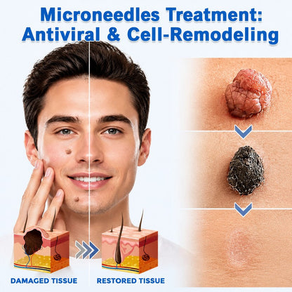 Acne patch applied to a facial blemish for focused spot treatment